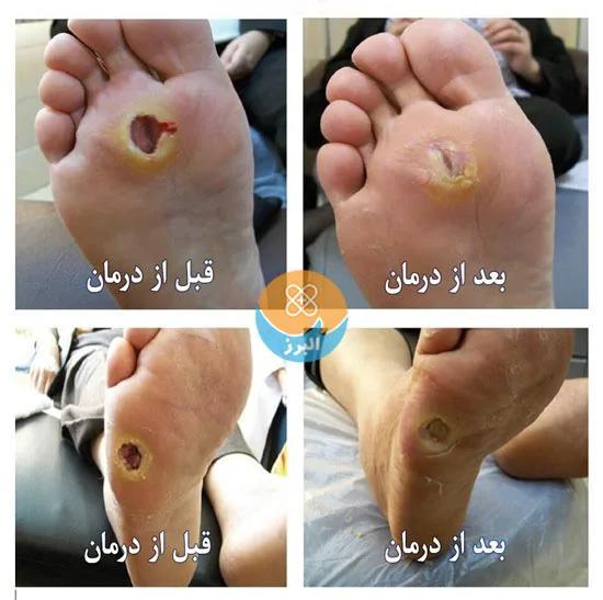 جلوگیری از قطع عضو با مراجعه به کلینیک زخم