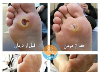 جلوگیری از قطع عضو با مراجعه به کلینیک زخم
